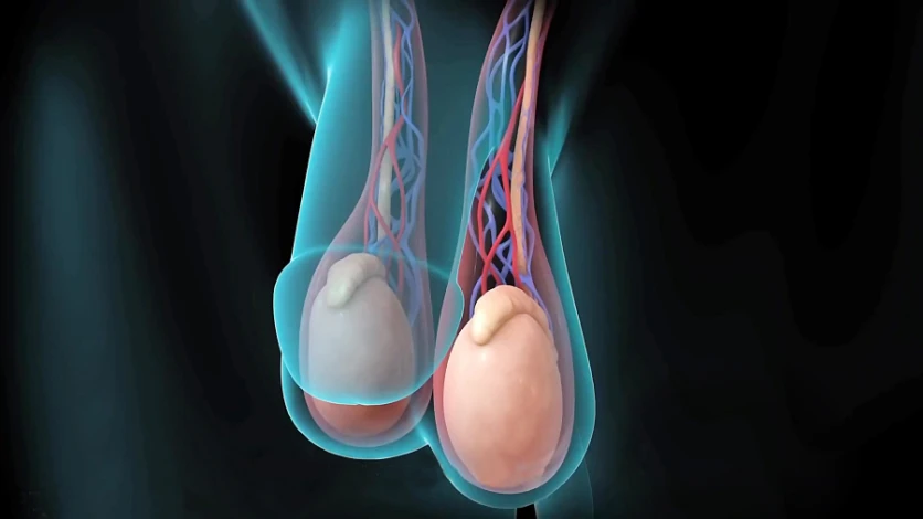 Cirurgia de varicocele microcirúrgica com ultrassom microdoppler vascular - Dr. Raphael Henrique